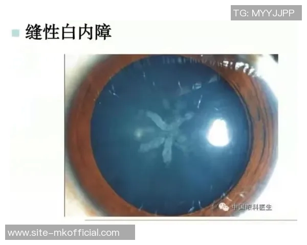 西媒揭示赫伊森眼睛难以睁开的原因是先天性眼睑下垂但不影响视力